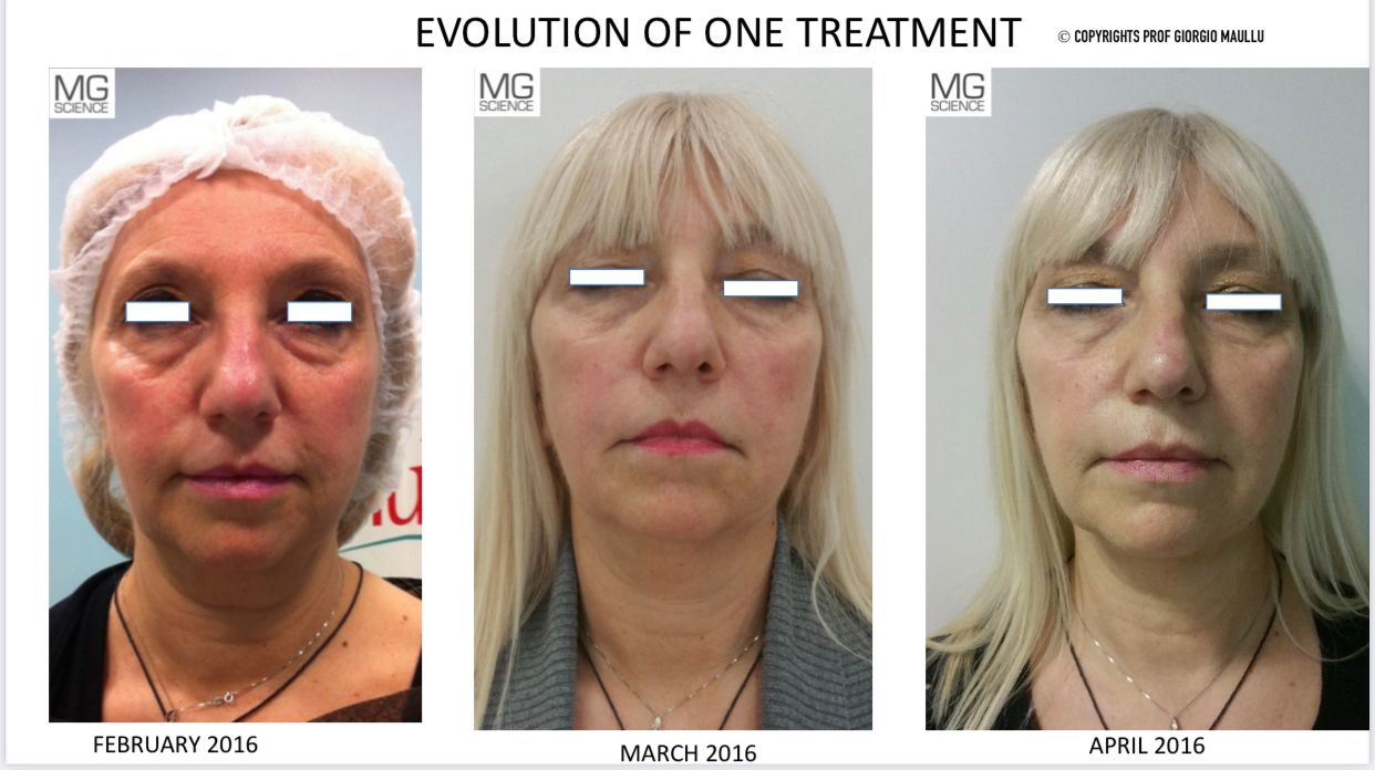 ATTIVA Face Treatment